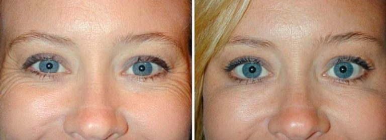 Какие глазные капли можно использовать при травме глаз